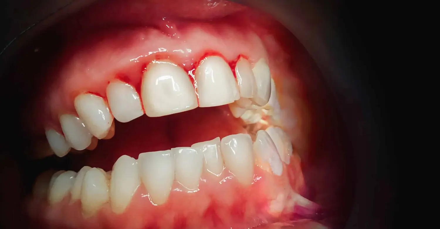 gum bleeding 2